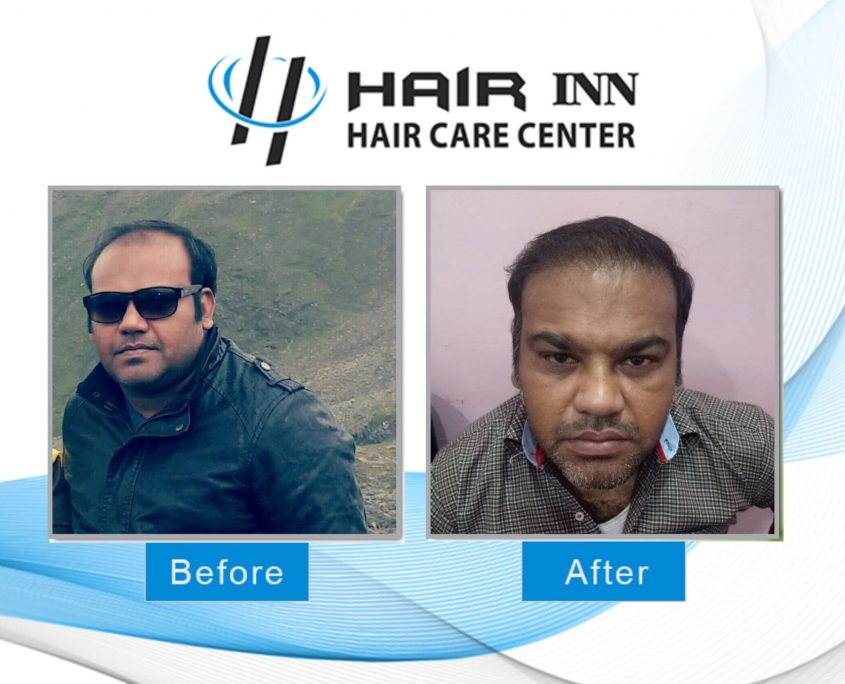 FUE Hair Transplant in Peshawar - Hair INN fue-hair-transplant-in-peshawar
