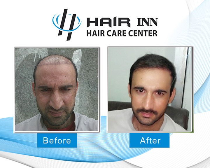 FUE Hair Transplant in Peshawar - Hair INN fue-hair-transplant-in-peshawar