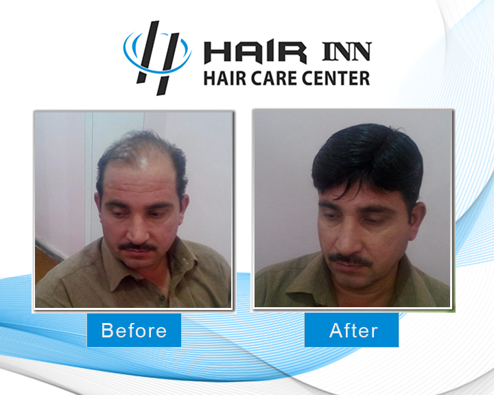 Non Surgical Hair Replacement In Peshawar - Hair INN in Peshawar