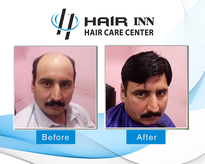 Non Surgical Hair Replacement In Peshawar - Hair INN in Peshawar